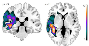 aphasia